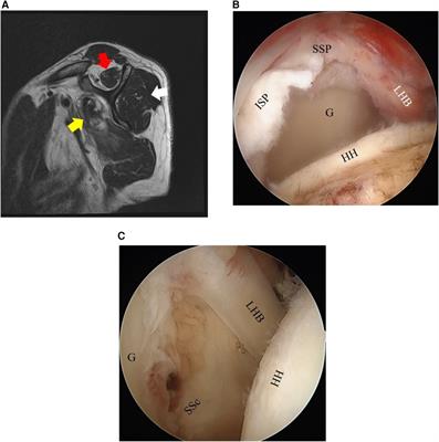 Associations between fatty infiltration of rotator cuff muscles and tear size or location of rotator cuff tendon